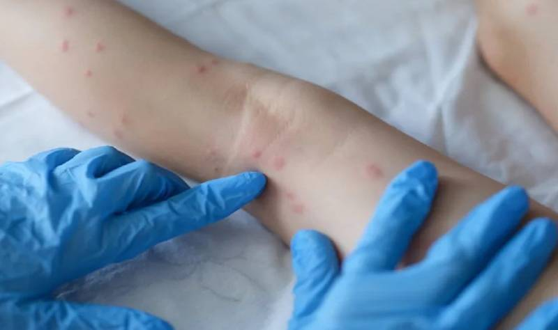 Cidade de SP confirma primeiros casos da varíola dos macacos em crianças