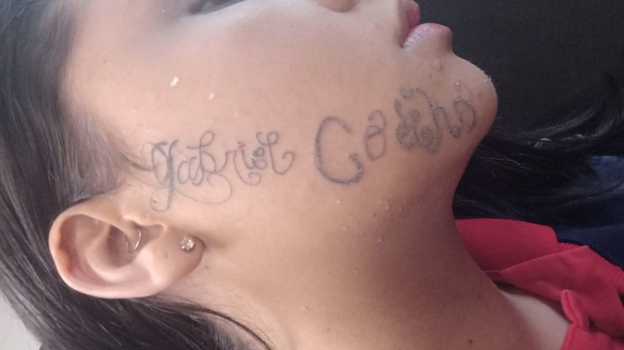 Tayane Cristine iniciou o processo de remoção da tatuagem Arquivo Pessoal