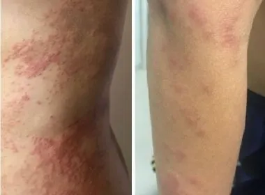 Moradores de Recife e Camaragibe relatam lesões na pele e coceiras
