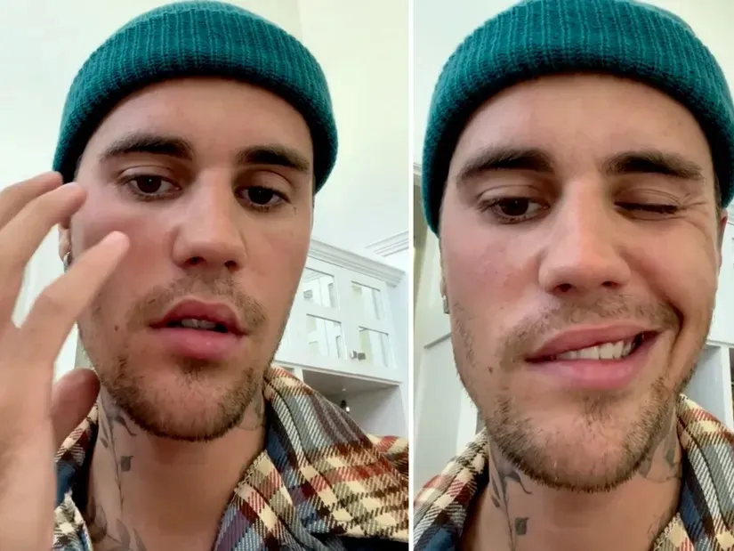 Justin Bieber está com o rosto parcialmente paralisado