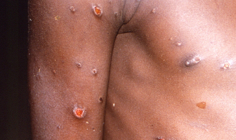 EUA identificam 9 casos da varíola do macaco em 7 estados