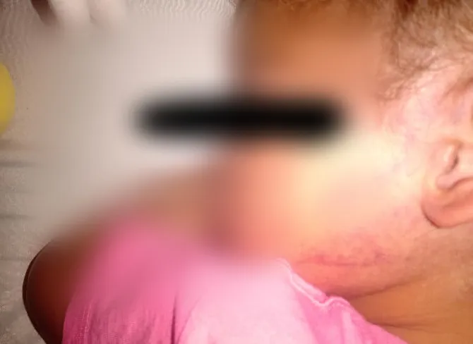 Menina de dois anos apresentava hematomas no rosto