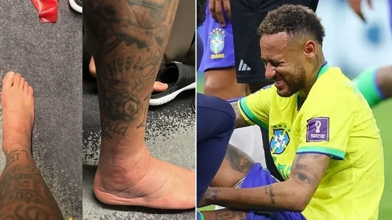 Neymar mostra inchaço no pé após entorse na estreia do Brasil na Copa