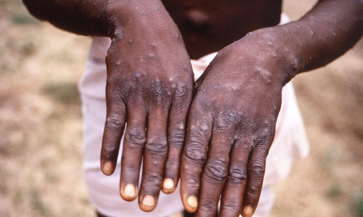 Número de casos de varíola na África Ocidental aumentou na última década