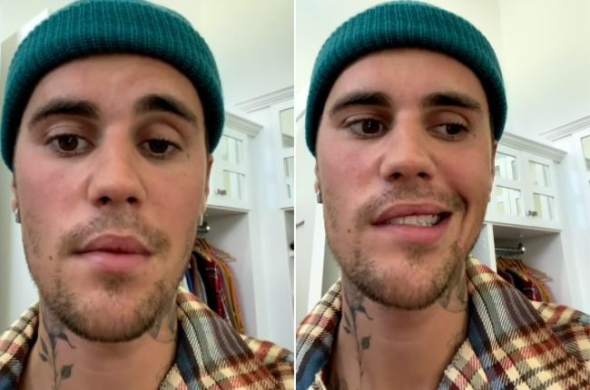 Justin Bieber aparece com rosto paralizado e revela doença Reprodução/Instagram