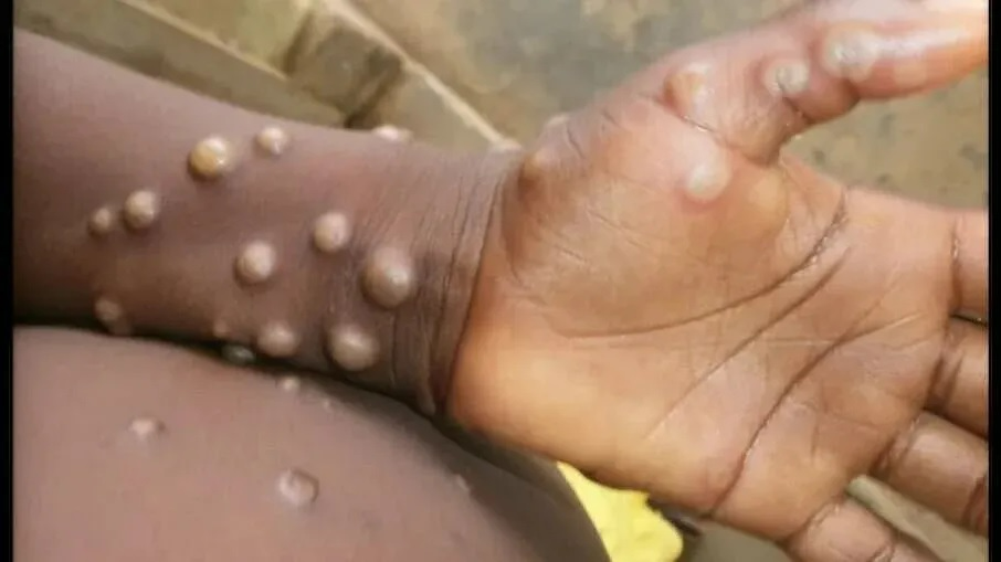 Indaiatuba confirma primeiro caso de varíola dos macacos