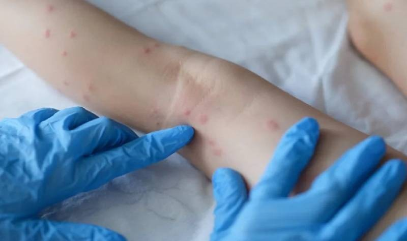 Campinas confirma mais sete casos de monkeypox e soma 27 infectados 